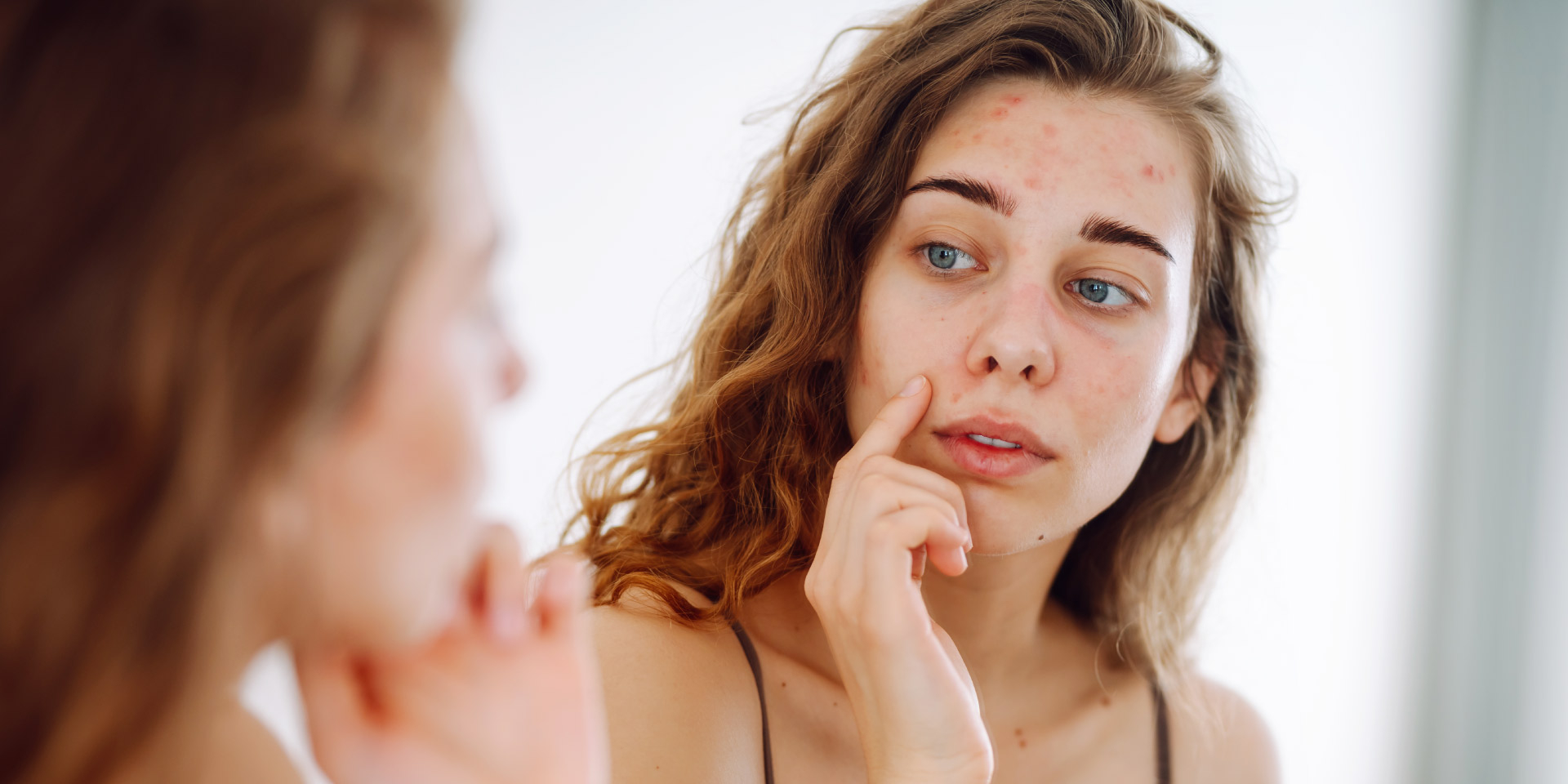 Como tratar acne adulto: rotina completa com os melhores produtos