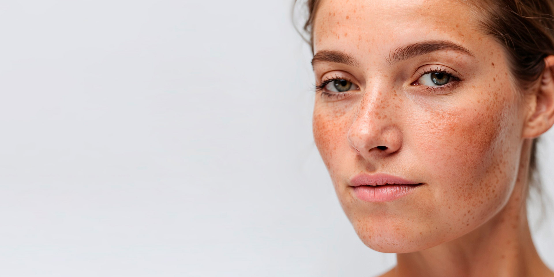 Melasma e manchas solares: o que fazer antes da exposição ao sol